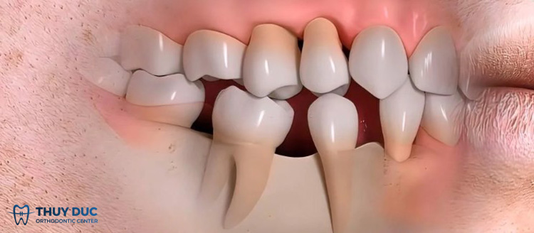 Hậu quả của răng bọc sứ bị viêm tủy 1