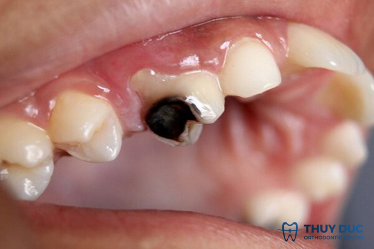 Trước khi bọc sứ không điều trị triệt để các bệnh lý răng miệng 1
