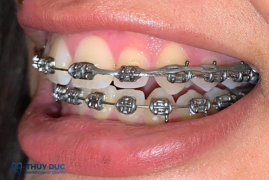 1. Dây thun chỉnh nha có những loại nào? 3