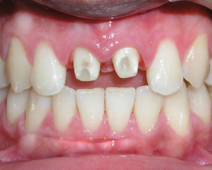 Khi nào nên bọc răng sứ cho 2 răng cửa? 1