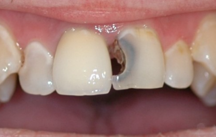Khi nào nên bọc răng sứ cho 2 răng cửa? 1