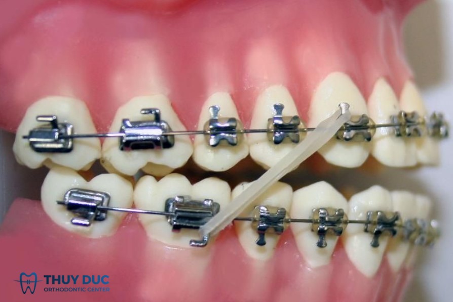 3.4. Thun liên hàm lớp 2 (Class II elastics) 1