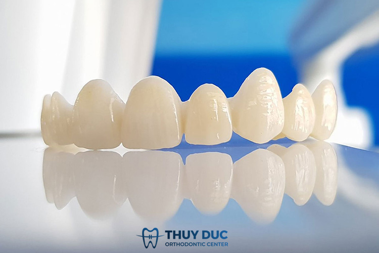 Các loại răng sứ chất lượng hàng đầu 1