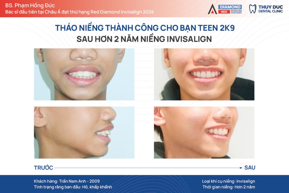 Niềng răng có làm môi dày lên không? 1