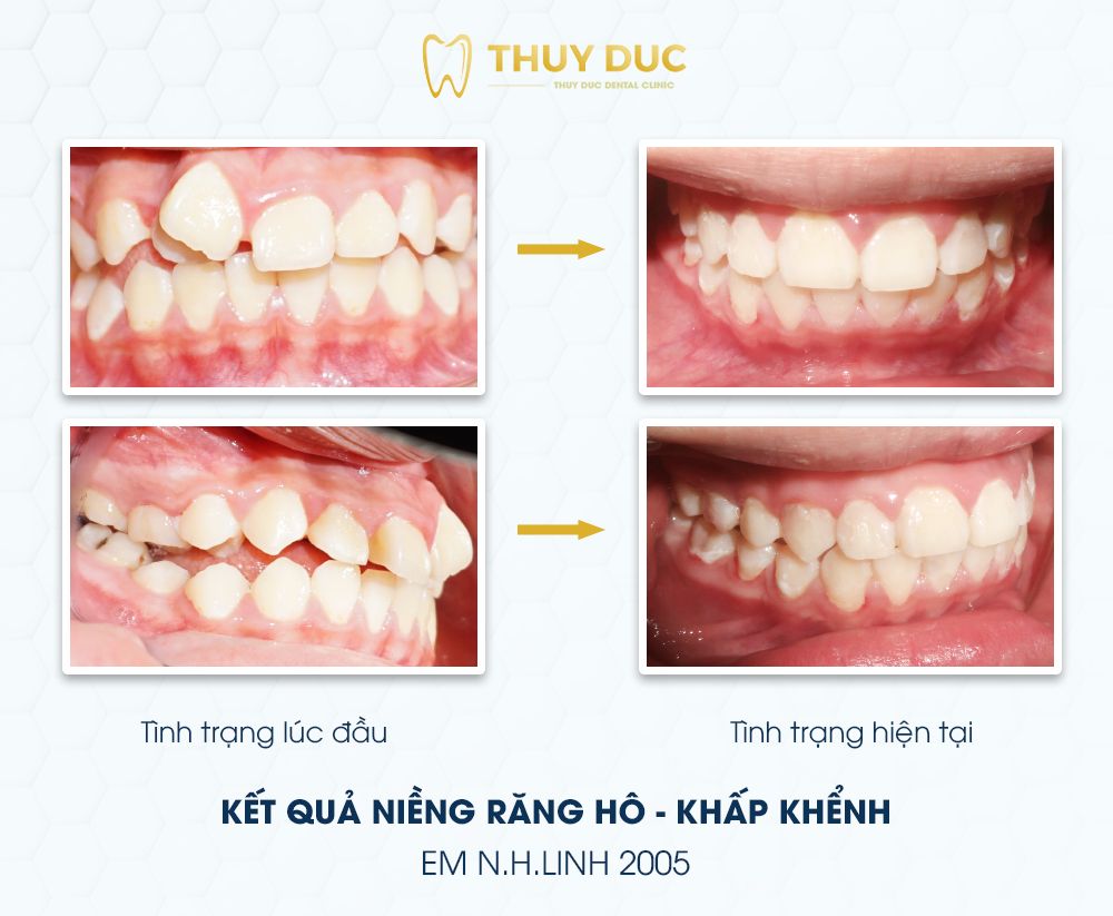 Hình ảnh răng vẩu thay đổi sau khi niềng tại Nha khoa Thúy Đức 12