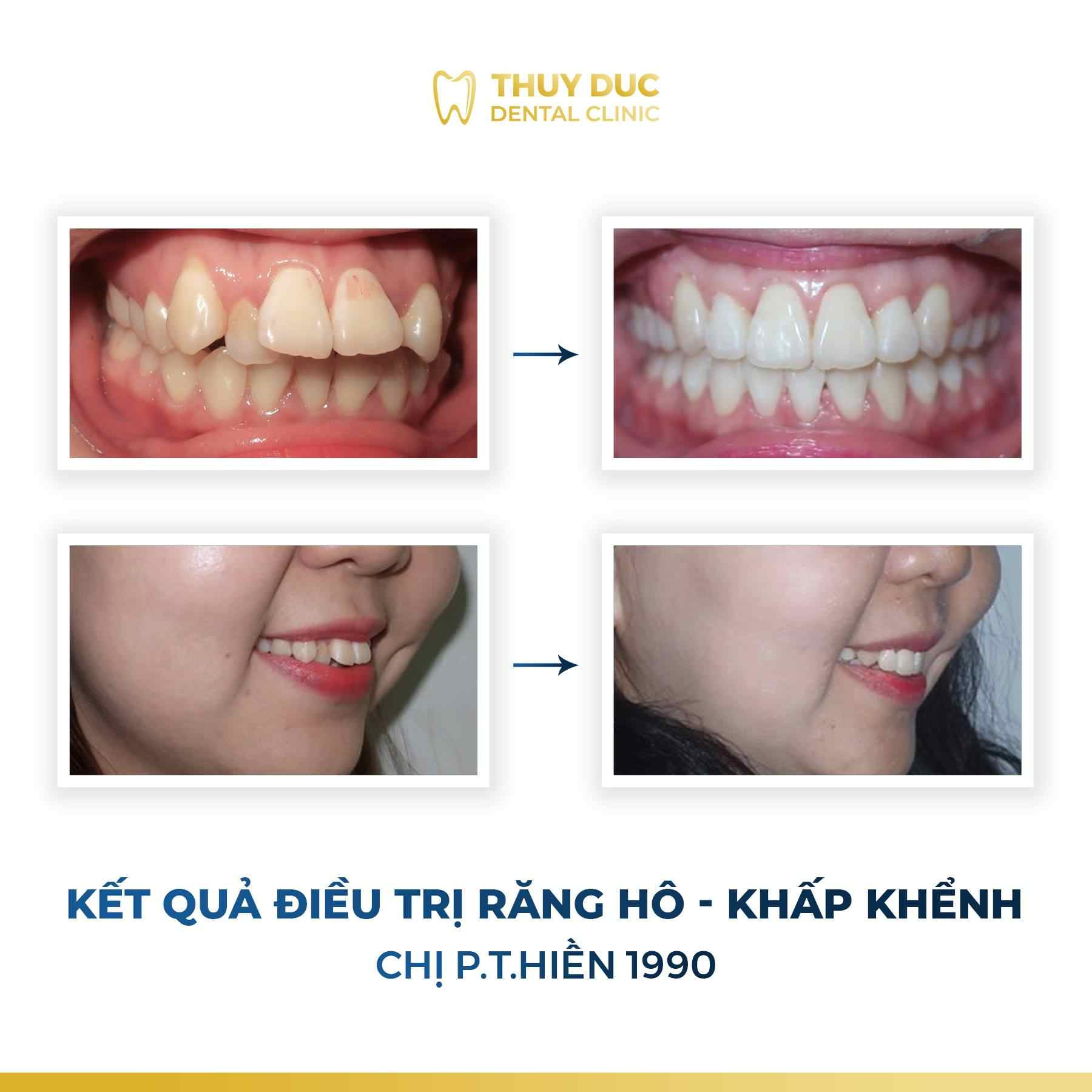 Hình ảnh răng vẩu thay đổi sau khi niềng tại Nha khoa Thúy Đức 11