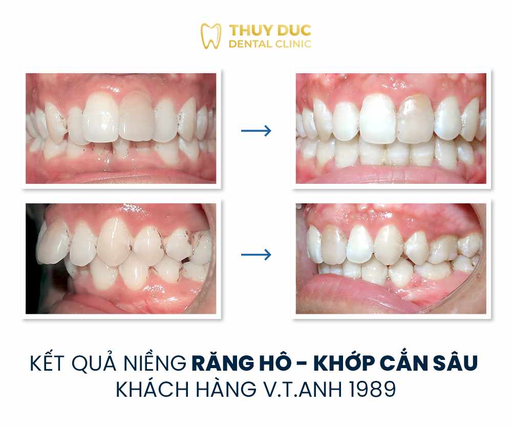 Hình ảnh răng vẩu thay đổi sau khi niềng tại Nha khoa Thúy Đức 22