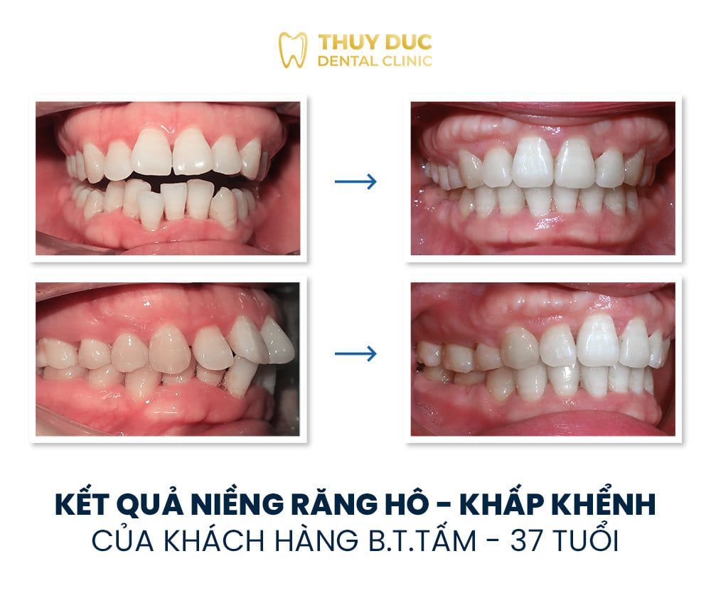 Hình ảnh răng vẩu thay đổi sau khi niềng tại Nha khoa Thúy Đức 14