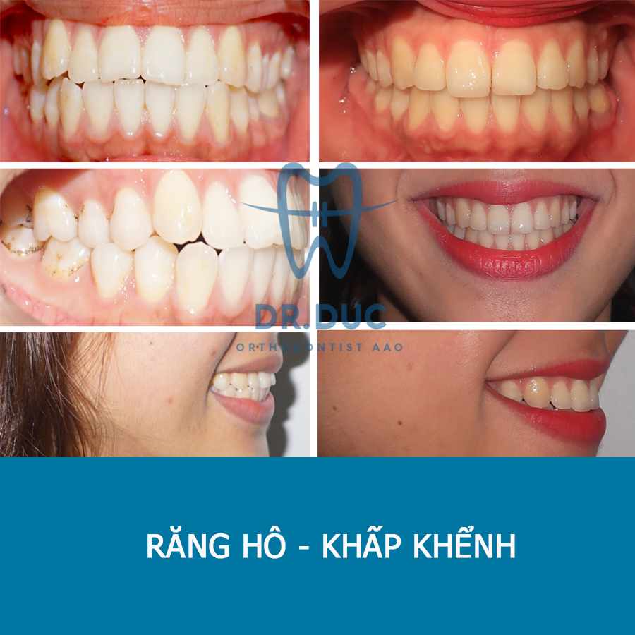 Hình ảnh răng vẩu thay đổi sau khi niềng tại Nha khoa Thúy Đức 19