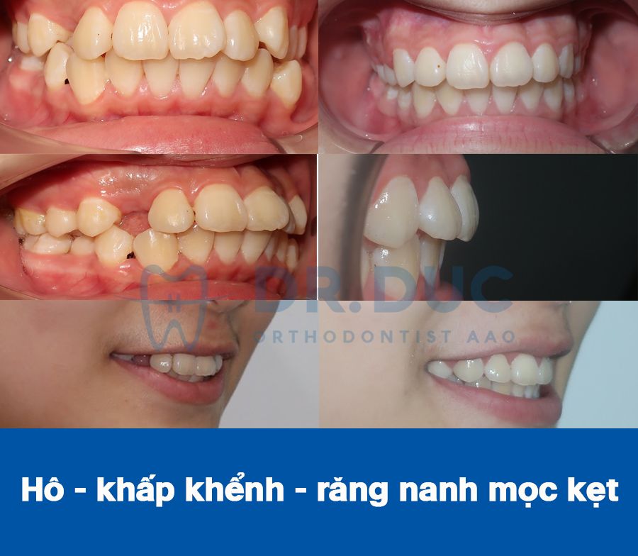 Hình ảnh răng vẩu thay đổi sau khi niềng tại Nha khoa Thúy Đức 15