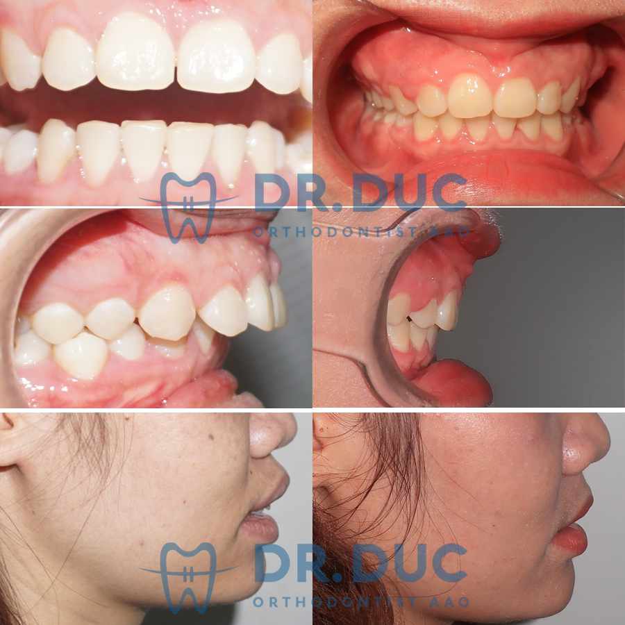 Hình ảnh răng vẩu thay đổi sau khi niềng tại Nha khoa Thúy Đức 21