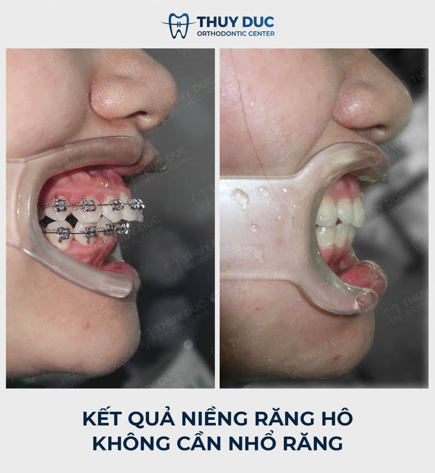 Hình ảnh răng vẩu thay đổi sau khi niềng tại Nha khoa Thúy Đức 5