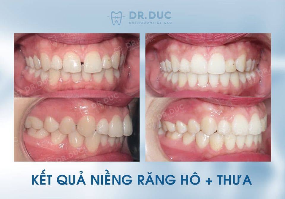 Hình ảnh răng vẩu thay đổi sau khi niềng tại Nha khoa Thúy Đức 10