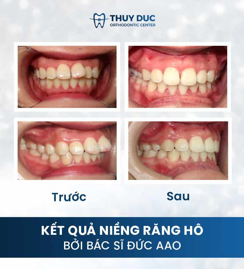 Hình ảnh răng vẩu thay đổi sau khi niềng tại Nha khoa Thúy Đức 17