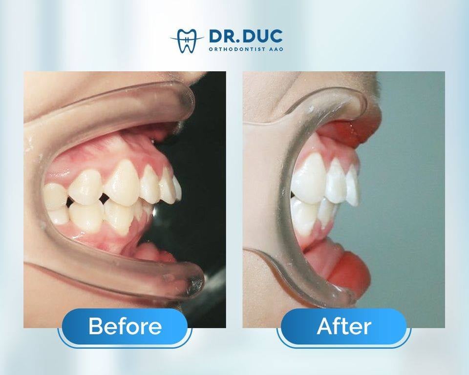 Hình ảnh răng vẩu thay đổi sau khi niềng tại Nha khoa Thúy Đức 9