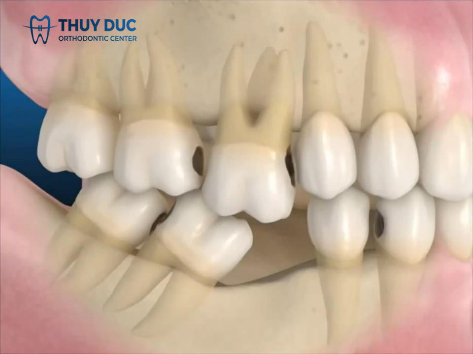 Trồng răng mới sau nhổ răng quan trọng thế nào? 1