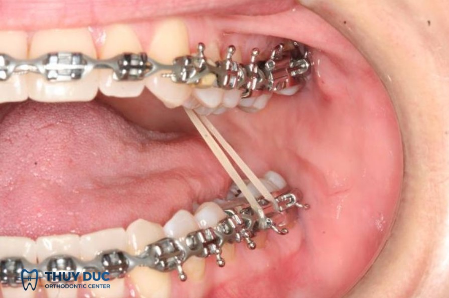 3.6. Các dạng khác ít phổ biến hơn 1