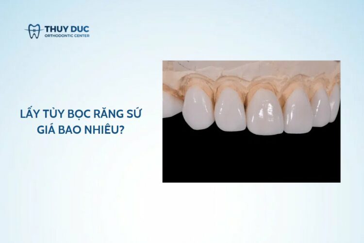Lấy tủy bọc răng sứ giá bao nhiêu?