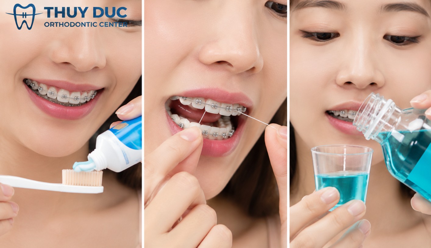 3. Những điều cần lưu ý khi đeo hàm duy trì 1 3. Những điều cần lưu ý khi đeo hàm duy trì 1