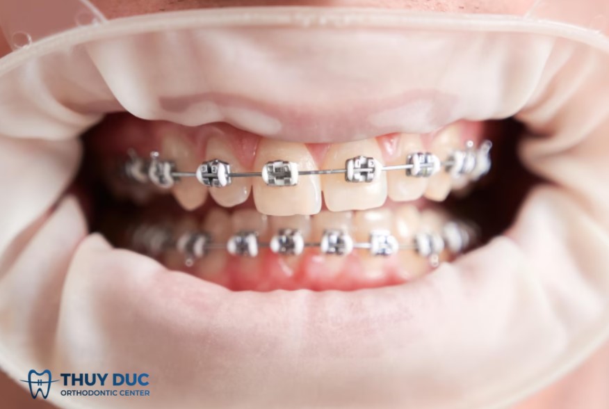 Niềng răng có phun môi được không? 1