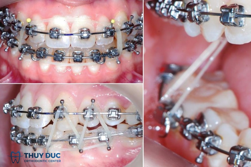 4. Hướng dẫn sử dụng thun liên hàm đúng cách 1