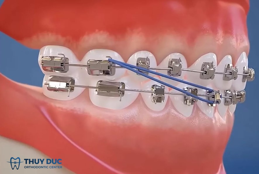 3.5. Thun liên hàm lớp 3 (Class III elastics) 1