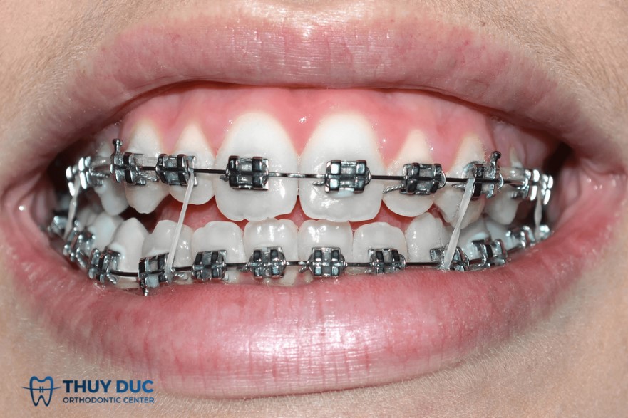 2.2. Di chuyển răng theo trục mong muốn 1