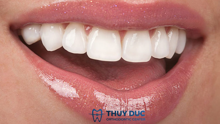 Những ưu điểm và hạn chế của răng sứ Emax 1