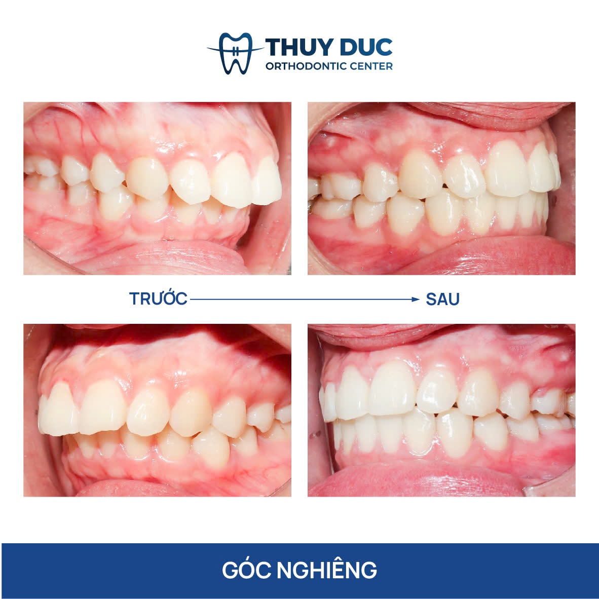 Hình ảnh răng vẩu thay đổi sau khi niềng tại Nha khoa Thúy Đức 22