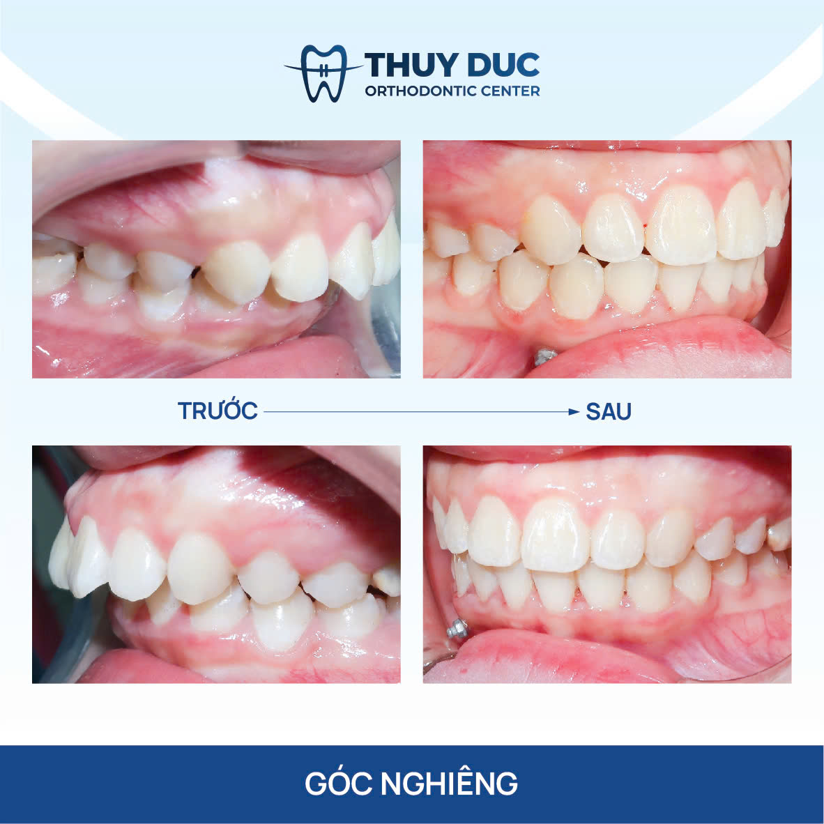 Hình ảnh răng vẩu thay đổi sau khi niềng tại Nha khoa Thúy Đức 18