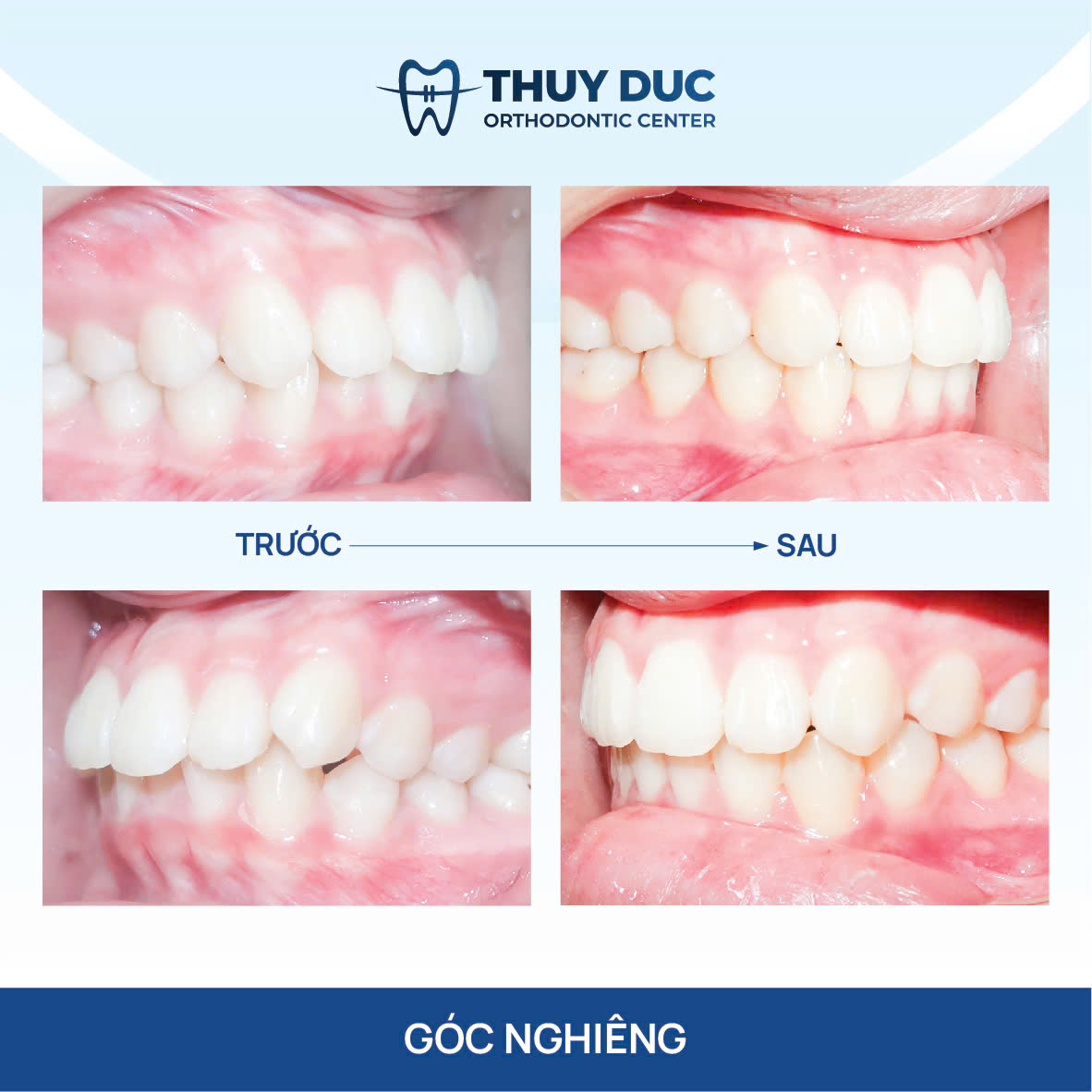 Hình ảnh răng vẩu thay đổi sau khi niềng tại Nha khoa Thúy Đức 13