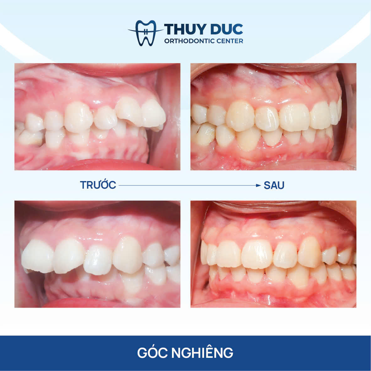 Hình ảnh răng vẩu thay đổi sau khi niềng tại Nha khoa Thúy Đức 7