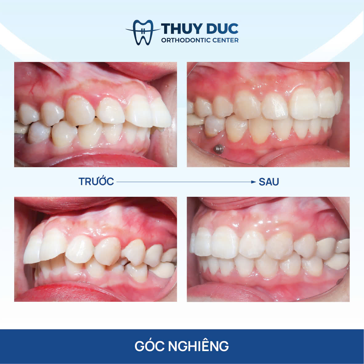 Hình ảnh răng vẩu thay đổi sau khi niềng tại Nha khoa Thúy Đức 11