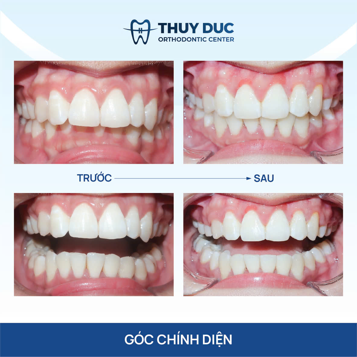 Hình ảnh răng vẩu thay đổi sau khi niềng tại Nha khoa Thúy Đức 2