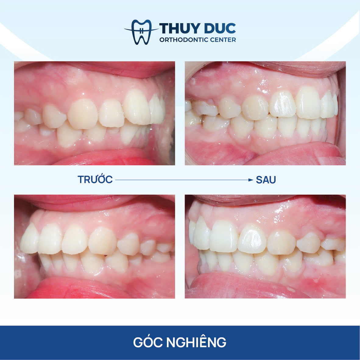 Hình ảnh răng vẩu thay đổi sau khi niềng tại Nha khoa Thúy Đức 1