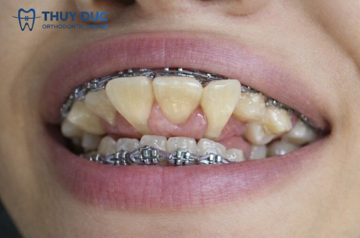 1.5. Hiện tượng bật chân răng ra ngoài (biến chứng nặng) 1