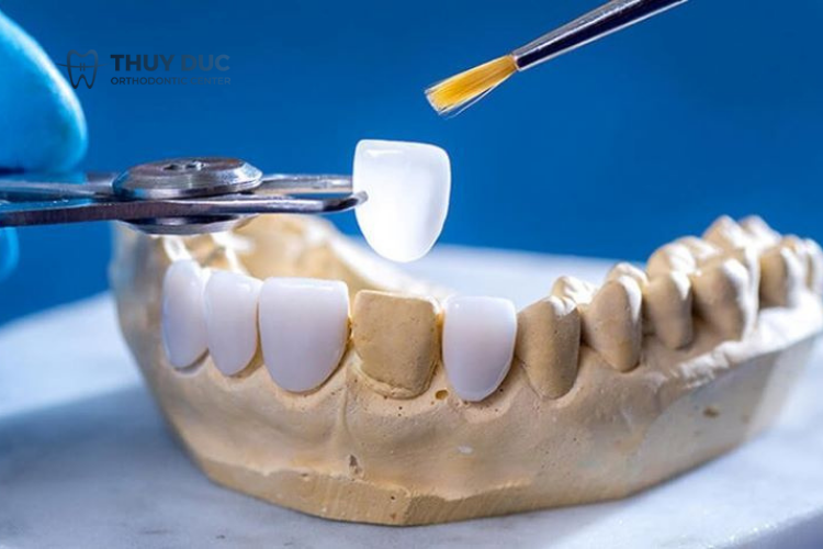 Nguyên nhân làm cho răng sứ bị hở chân răng 2 Nguyên nhân làm cho răng sứ bị hở chân răng 2