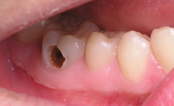 Răng hàm bị sâu 1