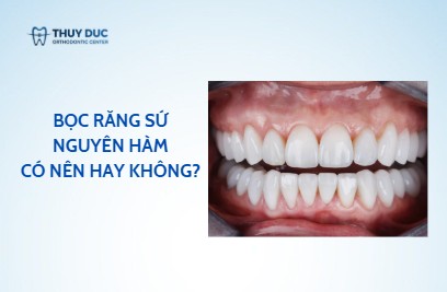 Bọc răng sứ nguyên hàm có nên không?