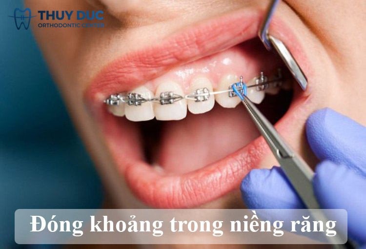 Có những phương pháp nào khác để đóng các khoảng trống giữa các răng trong quá trình chỉnh nha?
