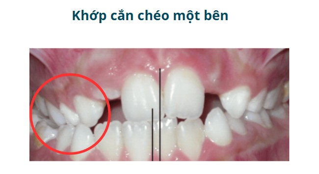 3. Khớp cắn chéo một bên (Unilateral Crossbite) 1