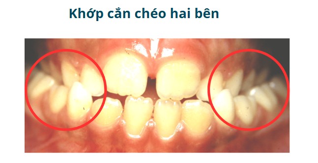 4. Khớp cắn chéo hai bên (Bilateral Crossbite) 1
