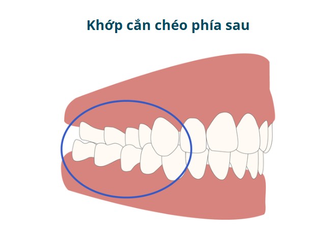2. Khớp cắn chéo phía sau (Posterior Crossbite) 1