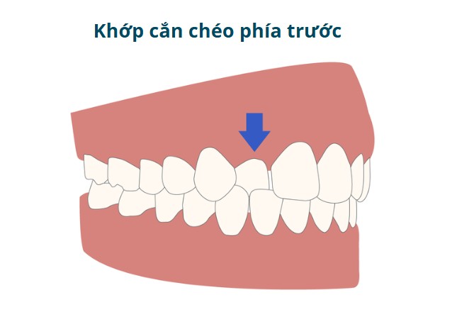 1. Khớp cắn chéo phía trước ( Anterior Crossbite) 1