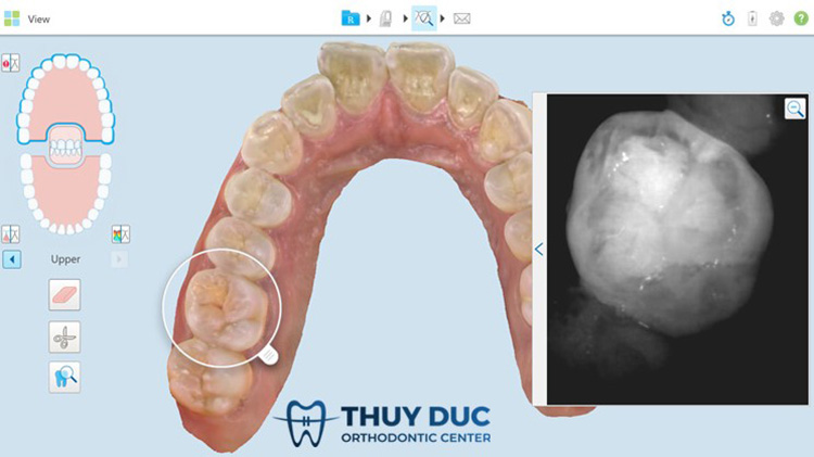 Công nghệ lấy dấu răng iTero 5D Plus mới nhất tại nha khoa Thúy Đức 2