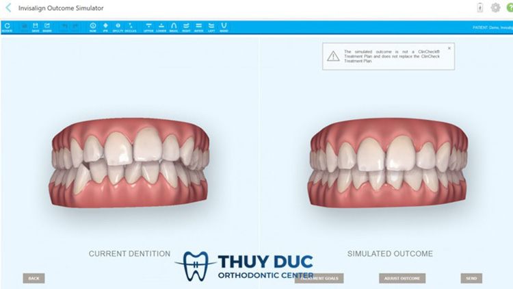 Công nghệ lấy dấu răng iTero 5D Plus mới nhất tại nha khoa Thúy Đức 3