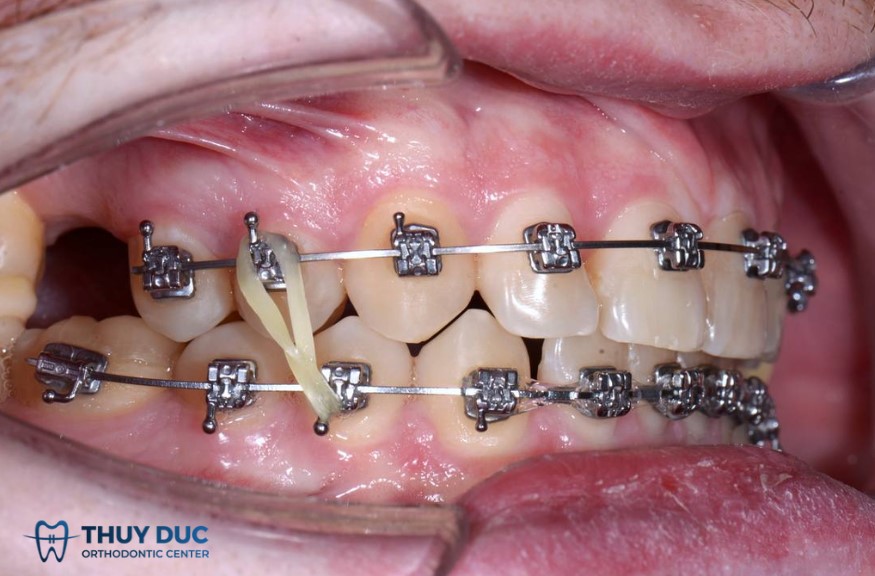 1.1. Răng di chuyển sai hướng hoặc không di chuyển 1