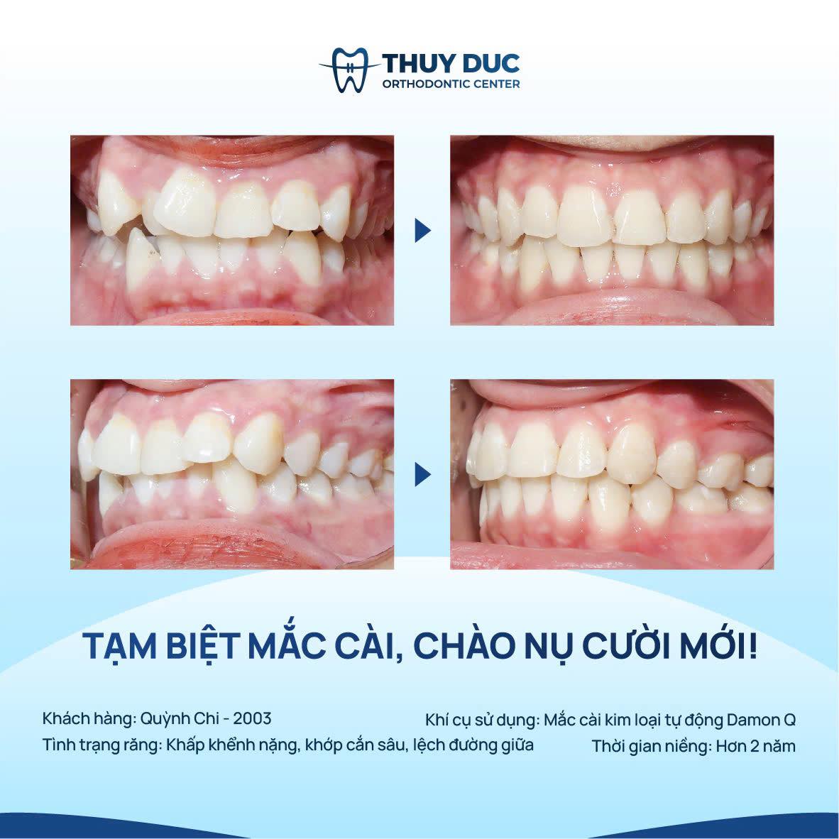 Nên niềng răng trong trường hợp nào? 1 Nên niềng răng trong trường hợp nào? 1