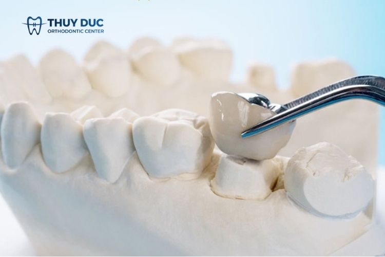 Bọc răng sứ implant răng toàn sứ 1