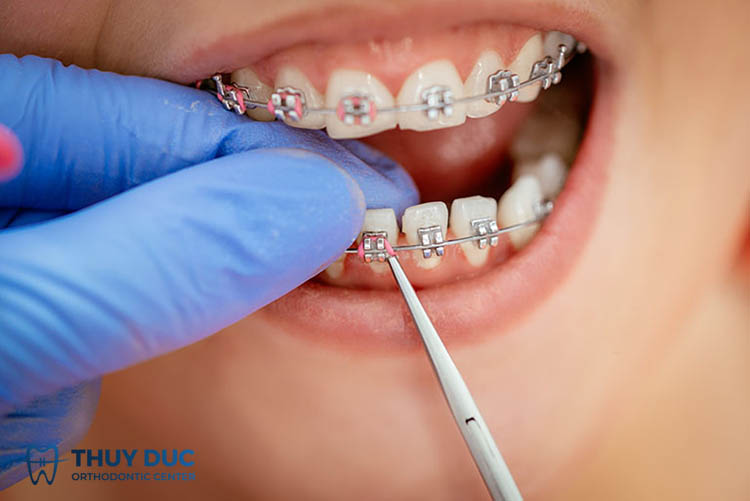 Quy trình siết răng khi niềng răng cụ thể nhất 1